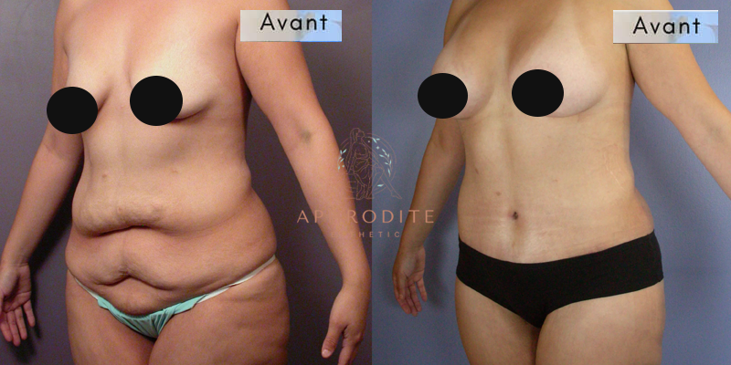 Body-lift avant apres