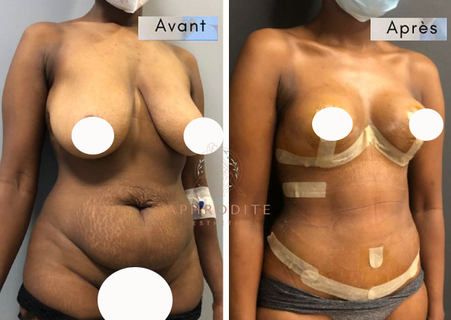 abdominoplastie avant apres