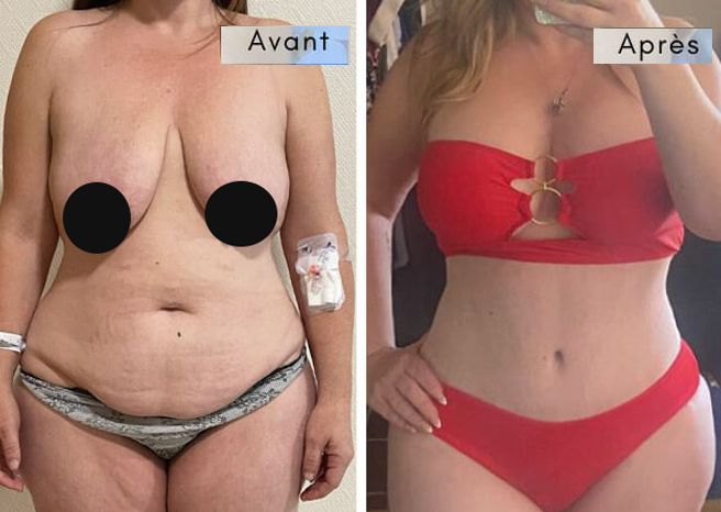 abdominoplastie avant apres