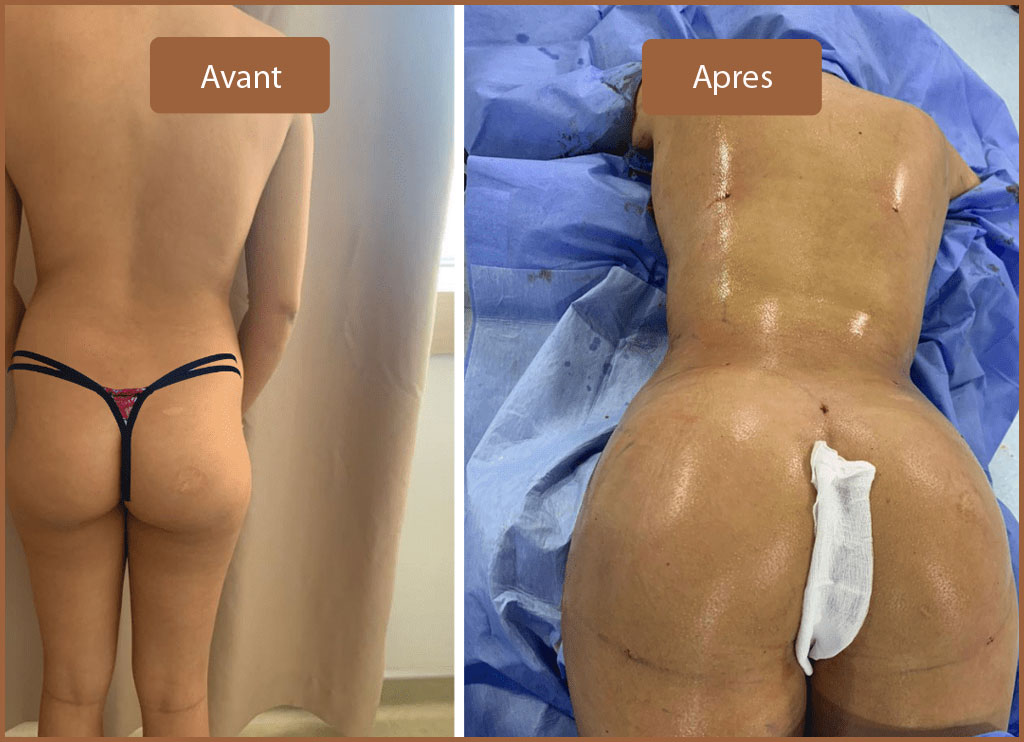 Lipofilling Fesses Tunisie