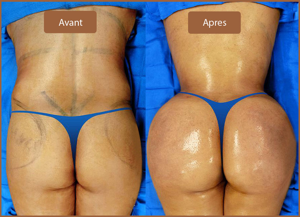 Lipofilling Fesses Tunisie