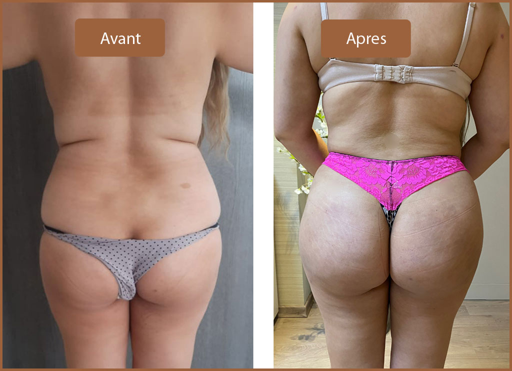 Lipofilling Fesses Tunisie