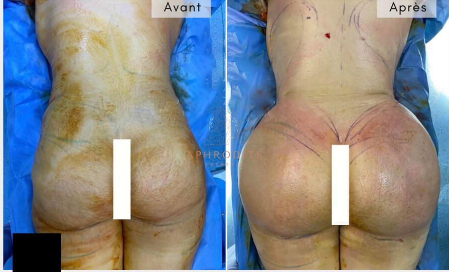 Augmentation des fesses avant apres