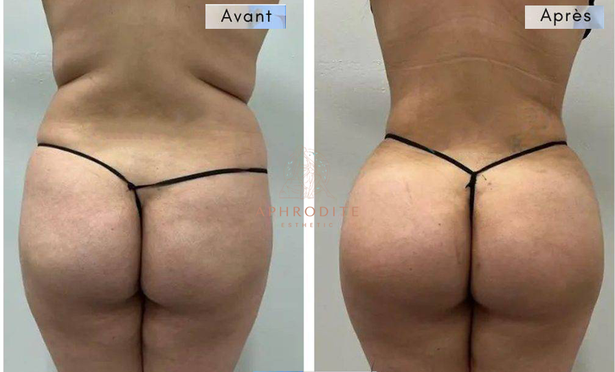 Augmentation des fesses avant apres