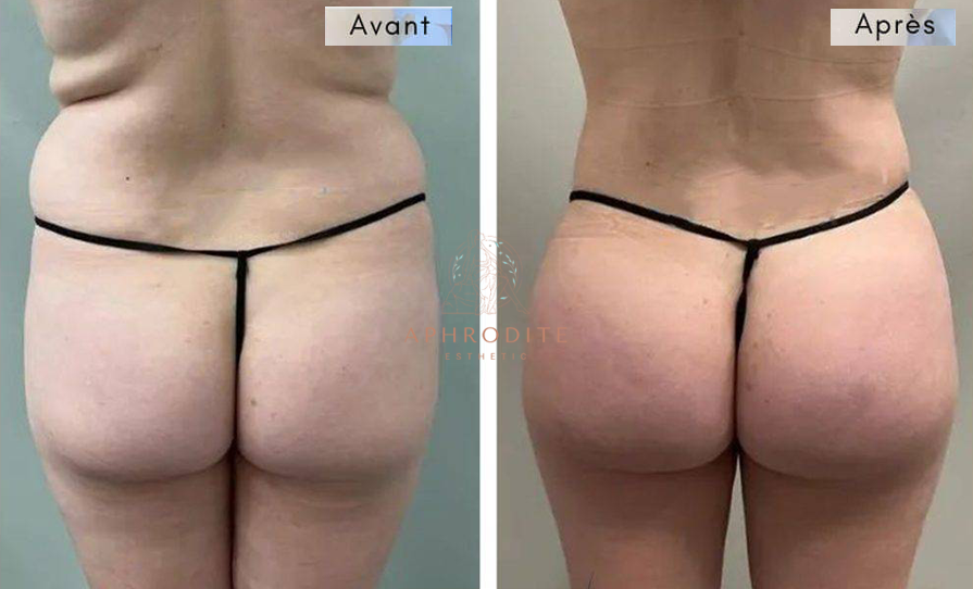 Augmentation des fesses avant apres