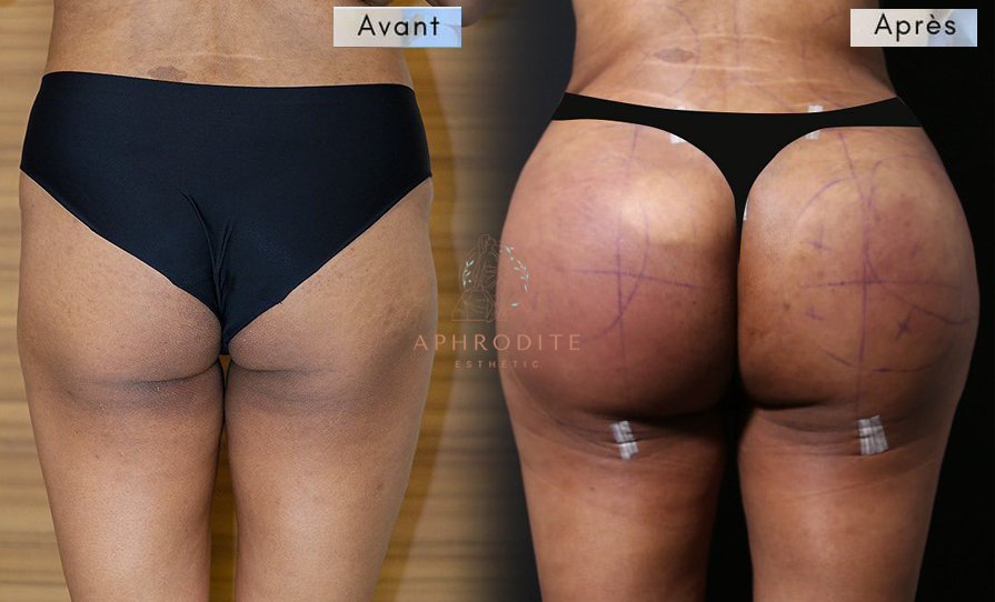 Augmentation des fesses avant apres