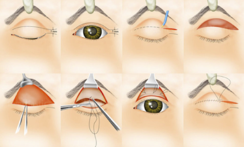 blépharoplastie en Tunisie avant apres