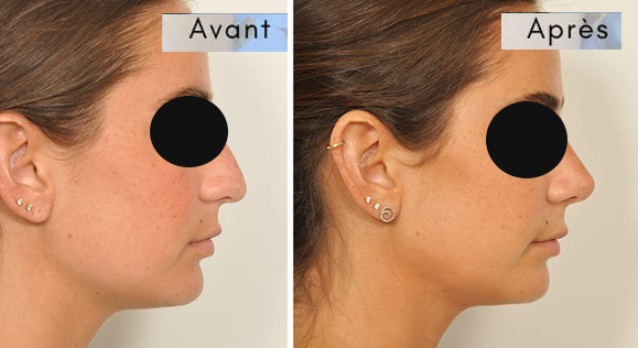 rhinoplastie avant apres