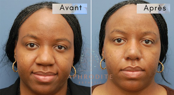 rhinoplastie avant apres