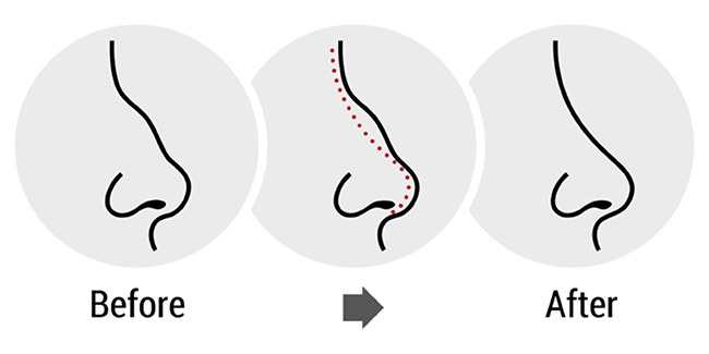 résultats d'une rhinoplastie en Tunisie