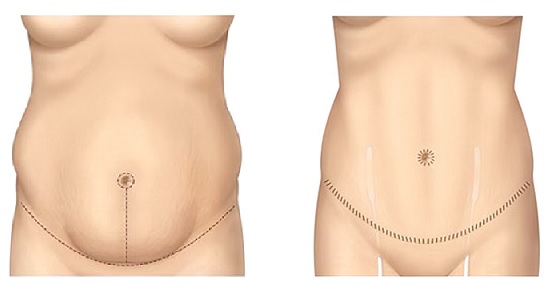 schema abdominoplastie avant apres