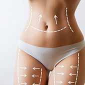 Abdominoplastie