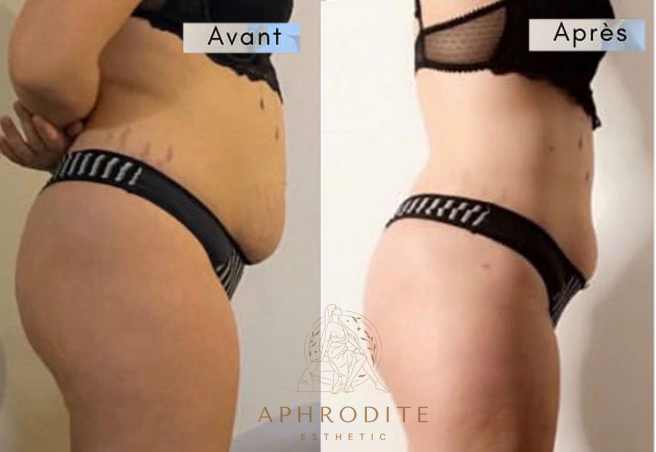 liposcussion avant apres