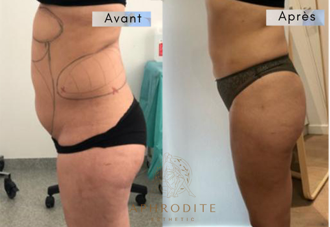liposcussion avant apres