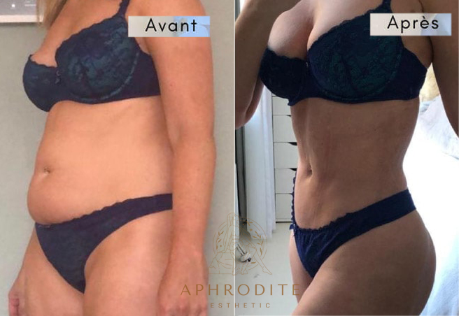 liposcussion avant apres