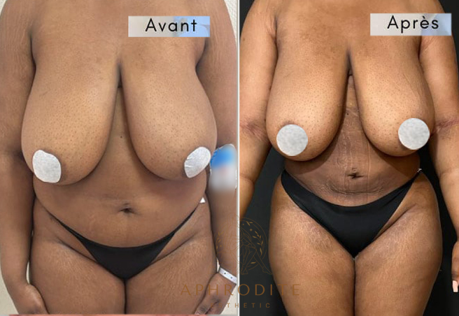 liposcussion avant apres