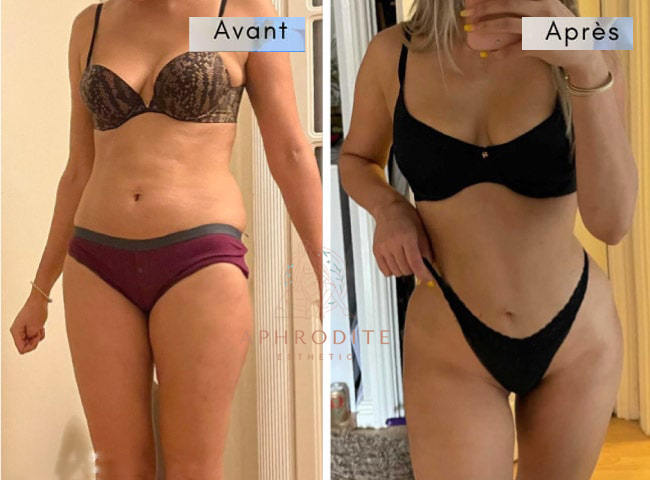 liposcussion avant apres